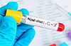 Nipah virus: Karnataka ramps up surveillance measures